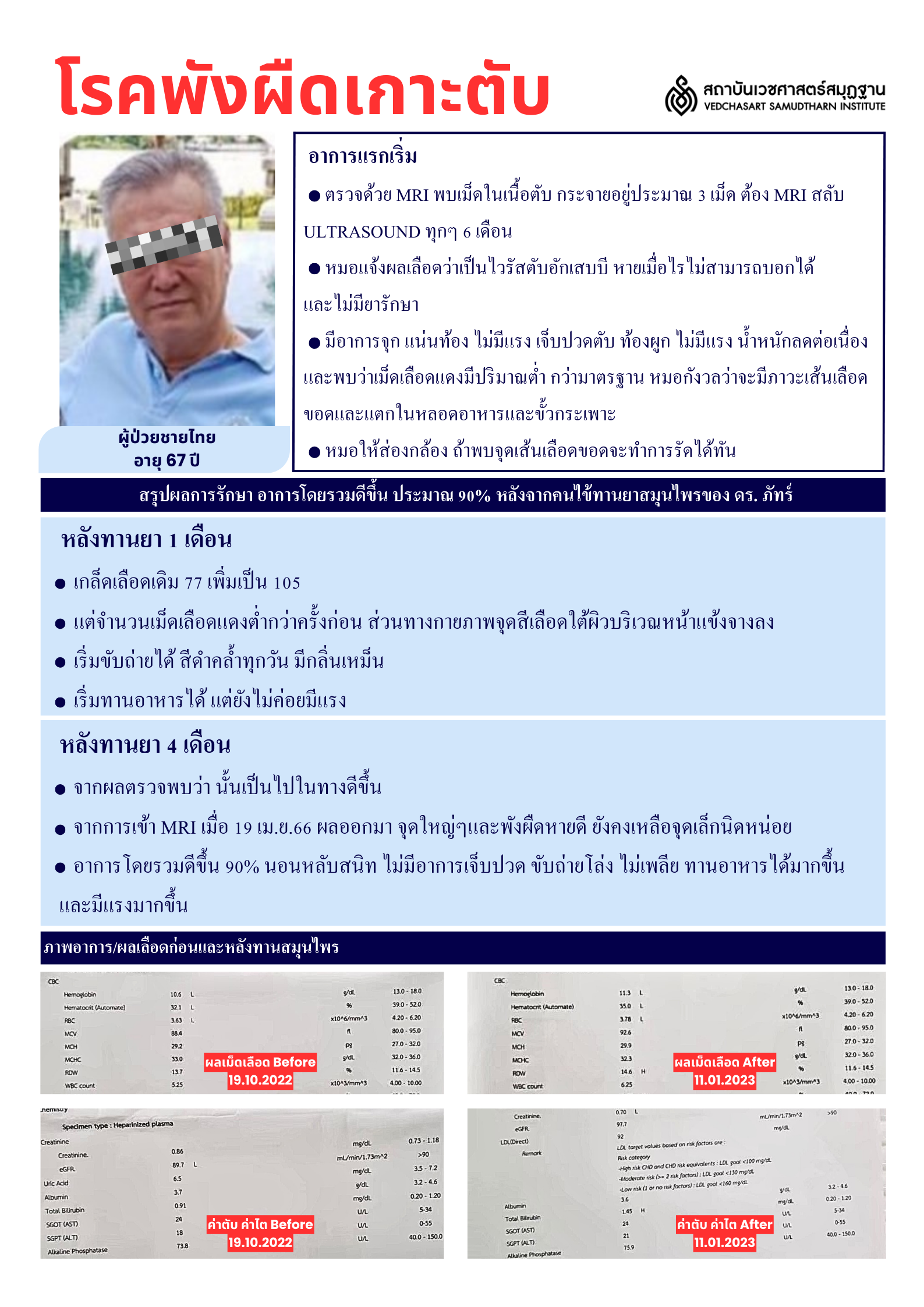 โรคตับ